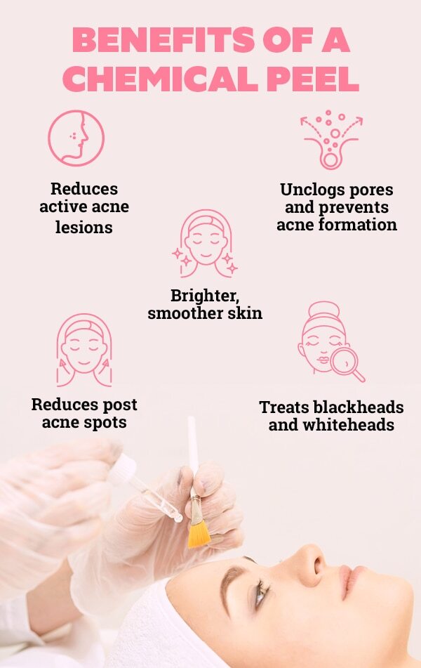 Are at-home chemical peels safe?