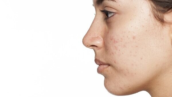 Are at-home chemical peels safe?