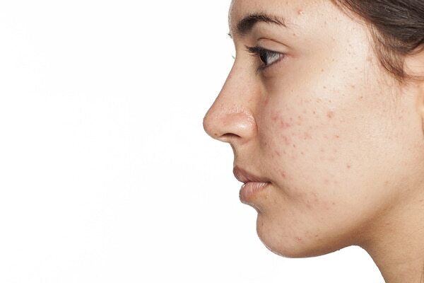 Are at-home chemical peels safe?