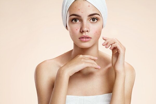 Are at-home chemical peels safe?