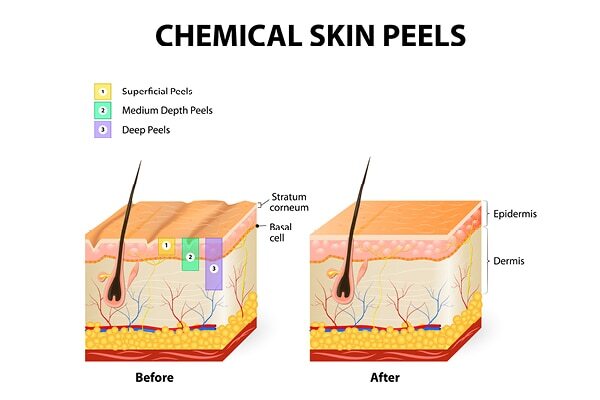 Are at-home chemical peels safe?