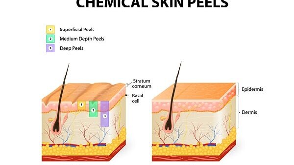 Are at-home chemical peels safe?