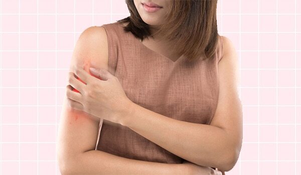 Pcos Awareness Month 2020: An Expert Tells You How To Deal With Itchy, Irritated Skin Caused Due To The Condition