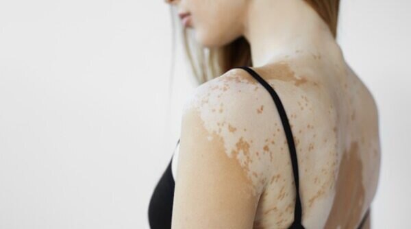 Everything You Need To Know About PityriasisVersicolor
