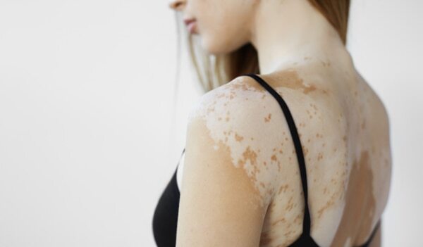 Everything You Need To Know About PityriasisVersicolor
