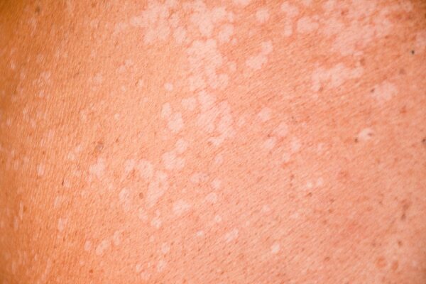 Preventing Pityriasis Versicolor
