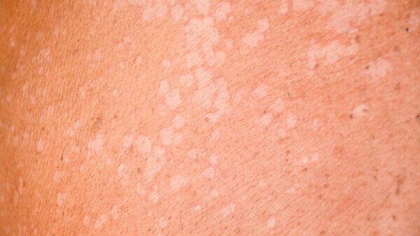 Preventing Pityriasis Versicolor