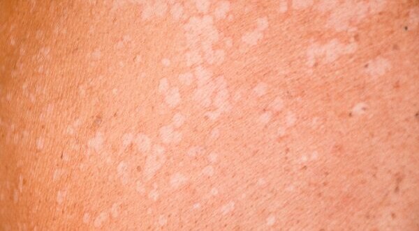 Preventing Pityriasis Versicolor