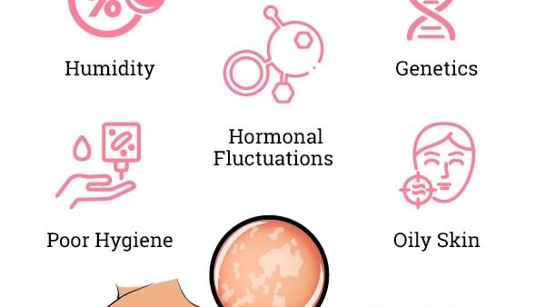 Preventing Pityriasis Versicolor