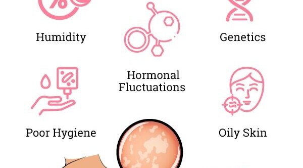 Preventing Pityriasis Versicolor