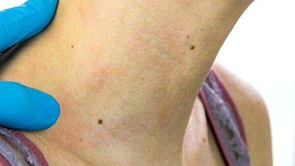Preventing Pityriasis Versicolor