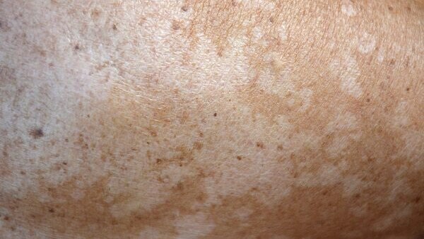 Preventing Pityriasis Versicolor