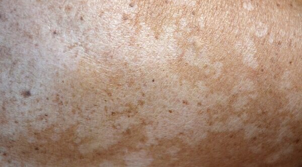 Preventing Pityriasis Versicolor