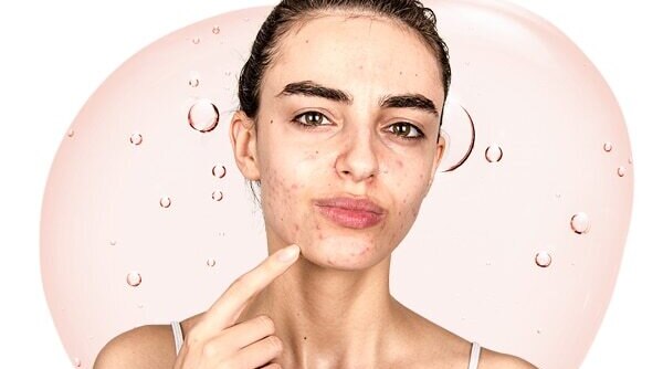 Here are the best serums to treat acne scars 