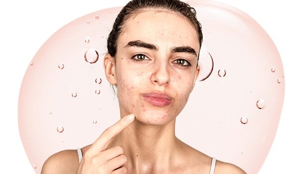 Here are the best serums to treat acne scars
