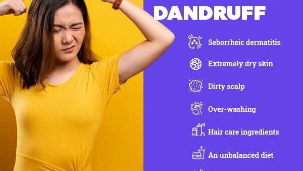 FAQs about the reasons for dandruff