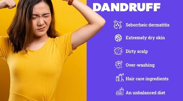 FAQs about the reasons for dandruff