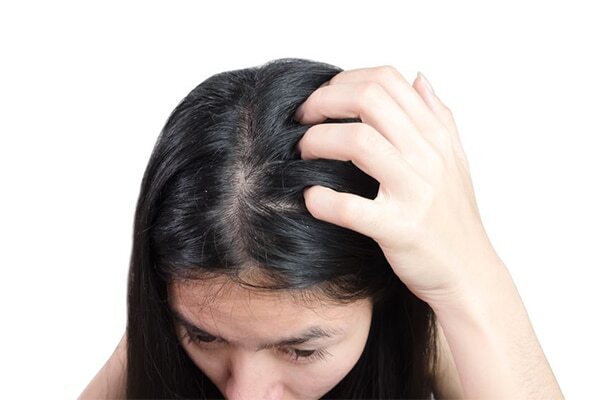FAQs about the reasons for dandruff