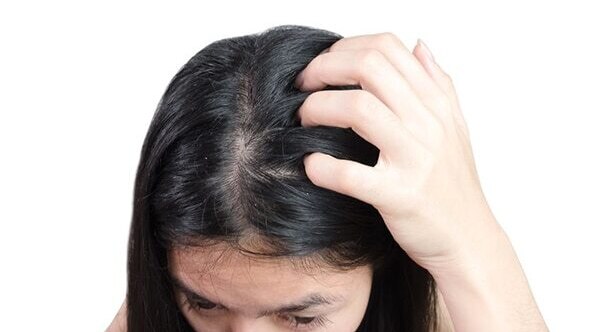 FAQs about the reasons for dandruff