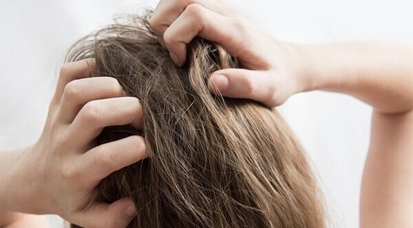 FAQs about the reasons for dandruff