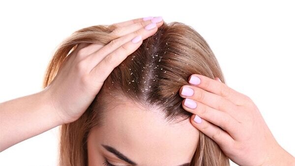 FAQs about the reasons for dandruff