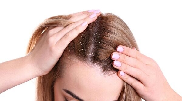 FAQs about the reasons for dandruff