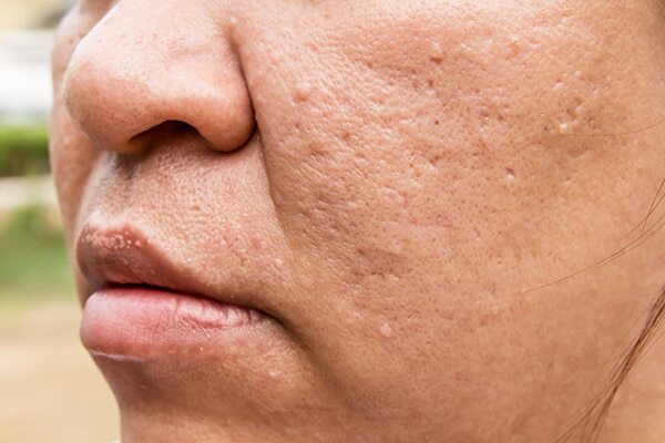 Essential oils for pockmarks