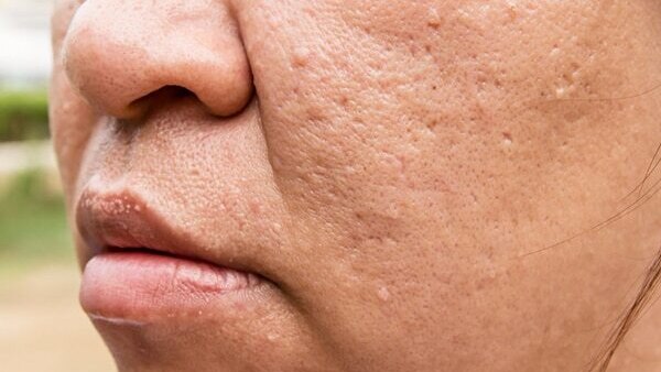 Essential oils for pockmarks