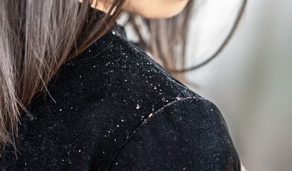 An Expert’s Guide To Proper Seborrheic Dermatitis Treatment