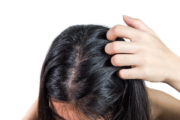 FAQs about seborrheic dermatitis