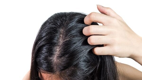 FAQs about seborrheic dermatitis
