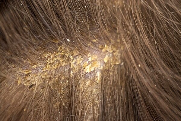 FAQs about seborrheic dermatitis