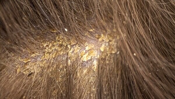 FAQs about seborrheic dermatitis