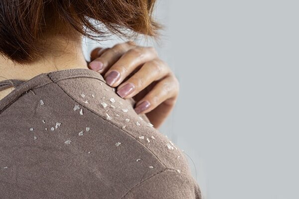 FAQs about seborrheic dermatitis
