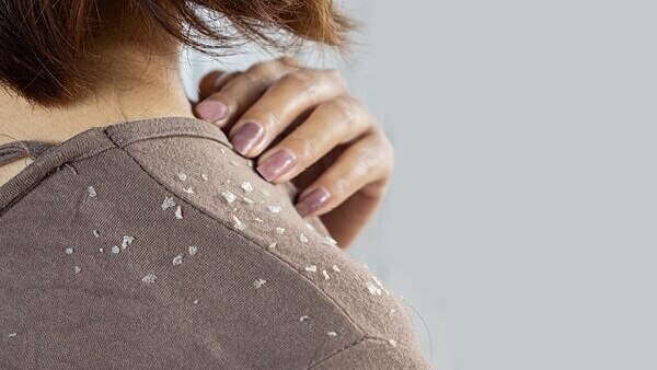 FAQs about seborrheic dermatitis