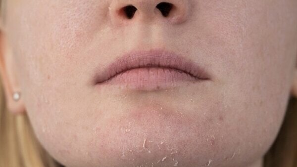 FAQs about skin peeling on face