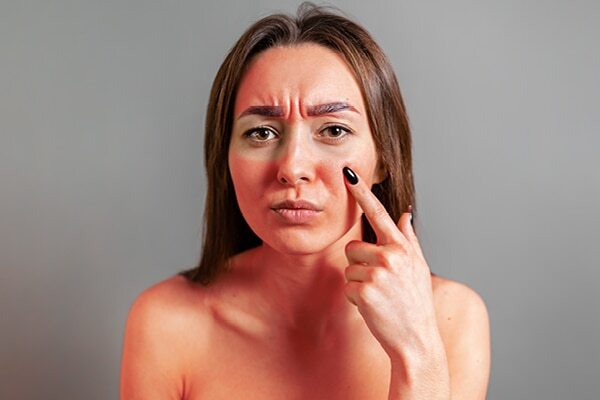 FAQs about skin peeling on face
