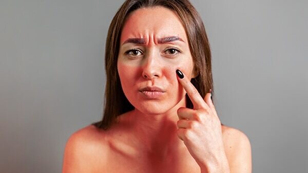 FAQs about skin peeling on face