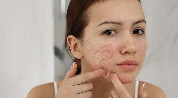 Can I use salicylic acid every day?