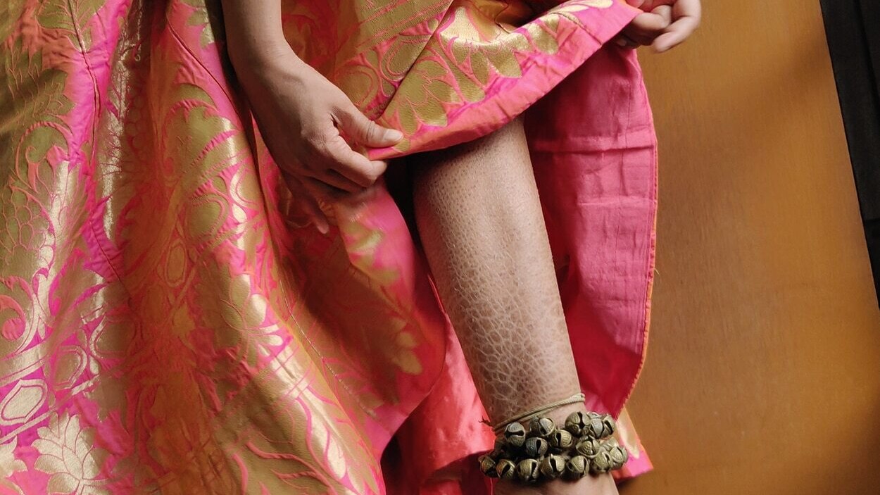 A dermatologist's guide on dealing with Ichthyosis Vulgaris