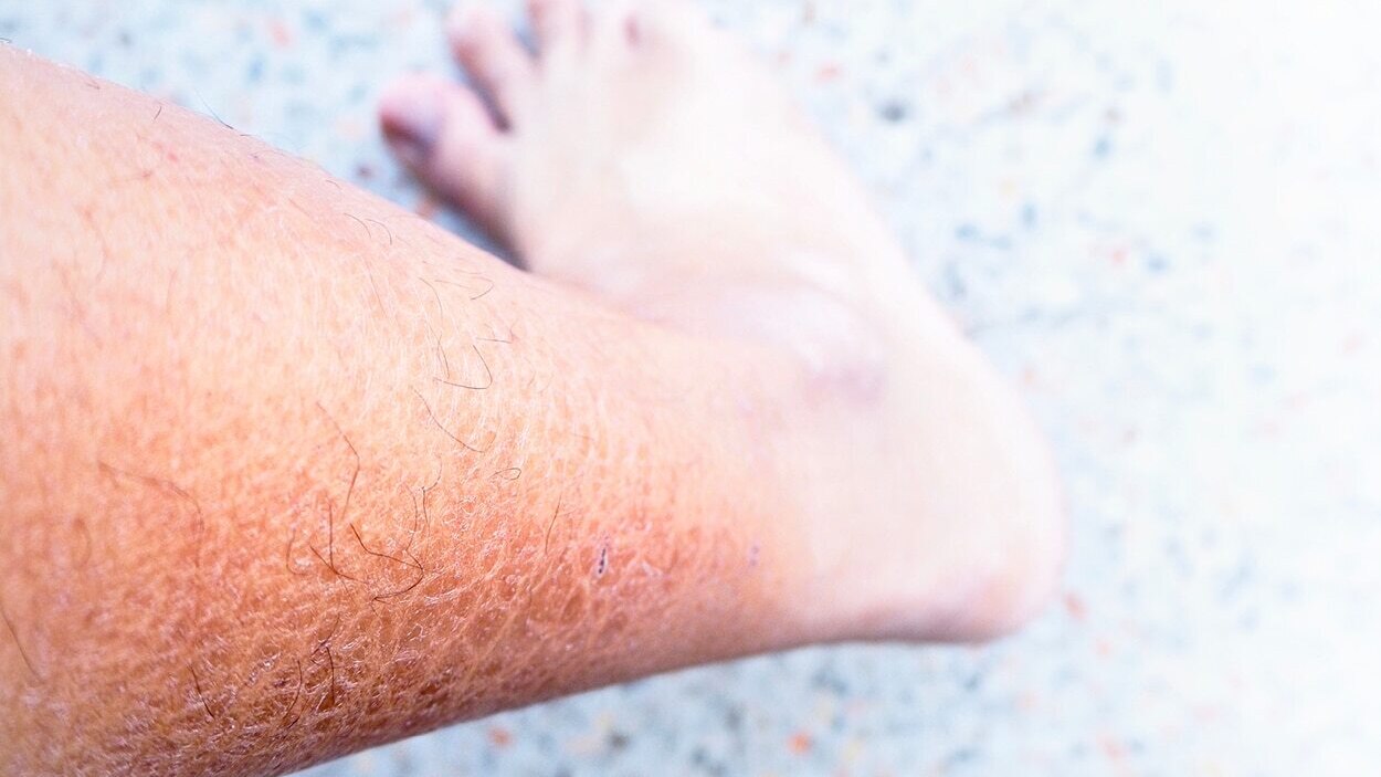 A dermatologist's guide on dealing with Ichthyosis Vulgaris