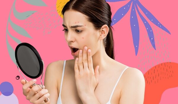 All About Fungal Acne: Causes, Symptoms And Treatment