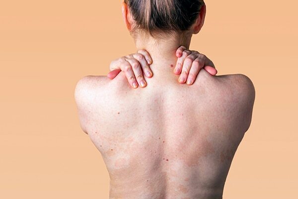 FAQs about fungal acne