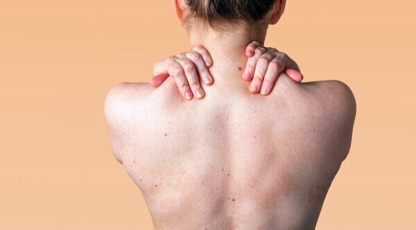 FAQs about fungal acne