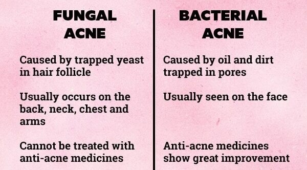 FAQs about fungal acne