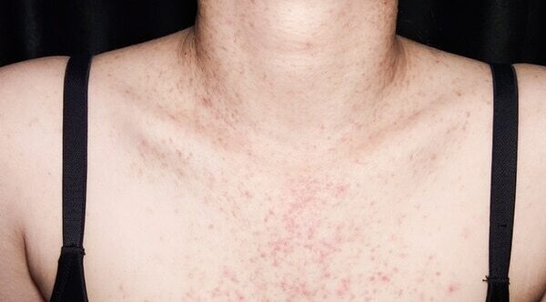 FAQs about fungal acne