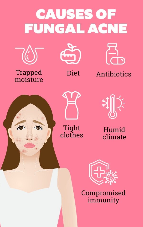FAQs about fungal acne