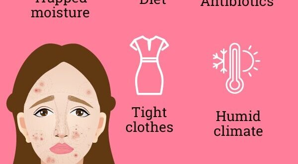FAQs about fungal acne