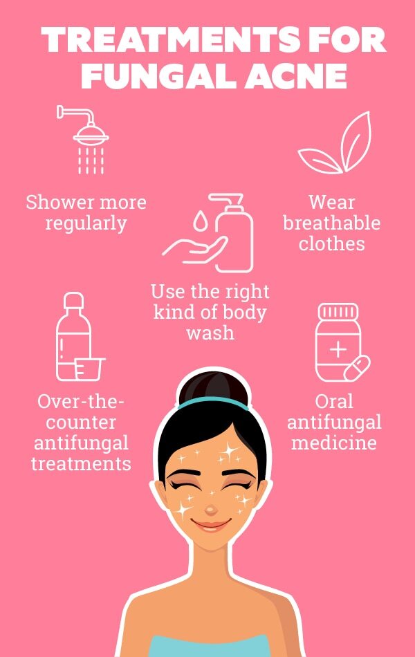 FAQs about fungal acne