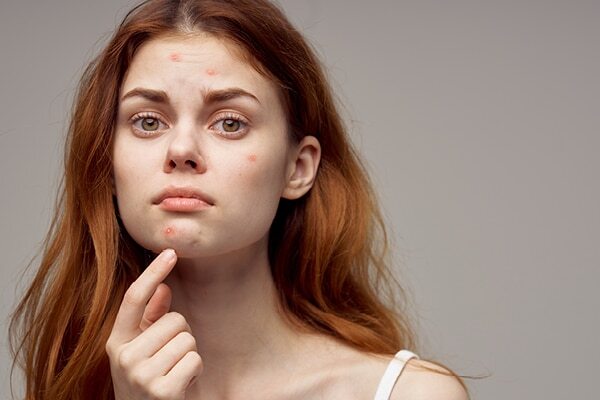 FAQs about honey for pimples